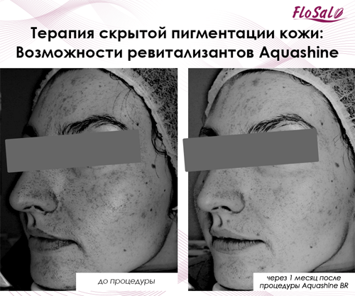 Терапия скрытой пигментации кожи: возможности ревитализантов Aquashine - Flosal