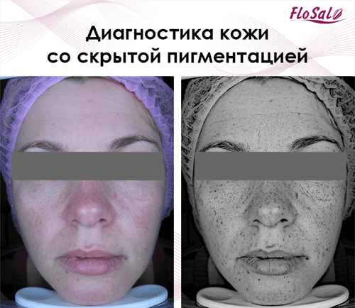 Диагностика кожи со скрытой пигментацией - FloSal