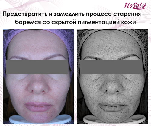 боремся со скрытой пигментацией кожи - FloSal